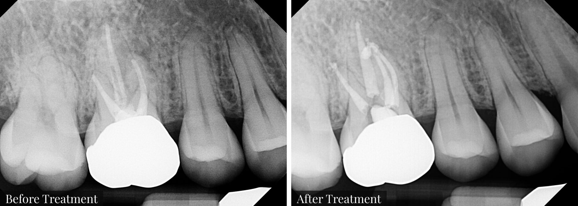 3-Retreatment